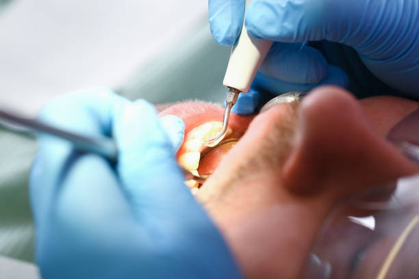 Best Chipped Tooth Repair Near Me  in Soh Salt Lake, UT