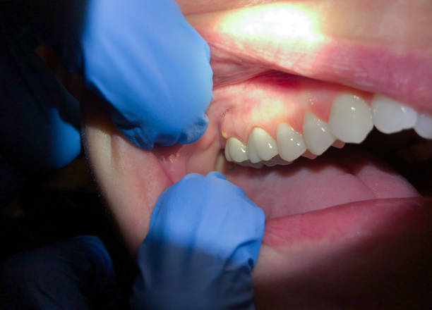 Best Cracked Tooth Emergency Dentist  in Soh Salt Lake, UT